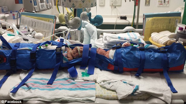 В США успешно прошла операция по разделению близнецов-краниопагов дети, операция, сша