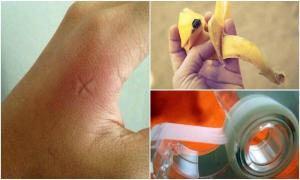 17 действенных советов, которые избавят вас от зуда после укусов комаров
